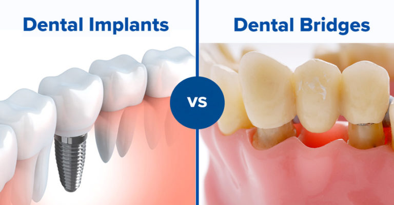 Dental Implants vs Crown Bridges - Dr. Karve's Dentech